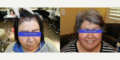 55-64 year old woman treated with Eyebrow Transplant, Hair Transplant - Here are some wonderful results only 7 months post surgery! She had her eyebrows and a Hair line restoration done ! Work done by Dr. Diep.