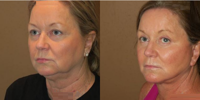 Woman treated with Facelift - Woman treated with Facelift