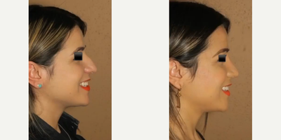 Woman treated with Rhinoplasty - Woman treated with Rhinoplasty