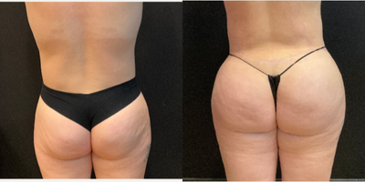 35-44 year old woman treated with Brazilian Butt Lift, Abdominal Etching - BBL + HD Lipo by Dr. Johnny Franco in Austin, TX