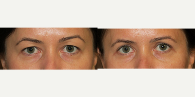 25-34 year old woman treated with Eyelid Surgery - upper blepharoplasty