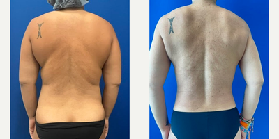 35-44 year old woman treated with Liposuction - Our patient is a 41 year old Female who is 1 year status post Tummy Tuck with Liposuction. She has had 2 C sections and was unhappy with the bulging of her abdomen, overhanging skin and overall abdominal contour. She is 52 and weighed 156 lbs on the day of surgery. Her current weight is 125 lbs. She has gone down several clothing sizes. She has focused on core exercising to help shape her abdominal muscle repair and squats to help support her lower back liposuction.