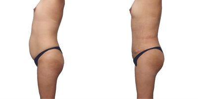 25-34 year old woman treated with Smart Lipo - 32 year old mother of 2. Mommy Makeover included Lipo 360 with snatched waist, BBL fat transfer to buttocks, fat transfer to breasts, and full tummy tuck with muscle tightening, diastasis repair, and new belly button done with scarless technique.
