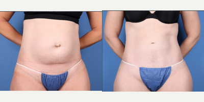 45 year old woman treated with Tummy Tuck, Power-Assisted Liposuction (PAL) - abdominoplasty with liposuction of trunk