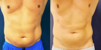 Man treated with truSculpt - Work on your summer body now! truBody is customized for fat reduction & muscle sculpting in a combined treatment.Reduce body fat up to an average of 24%Build muscle Increase basal metabolic rate (BMR)