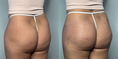 25-34 year old gender nonconforming person treated with Nonsurgical Butt Lift, Radiesse - Patient was treated with 10 syringes of hyper diluted Radiesse for butt augmentation