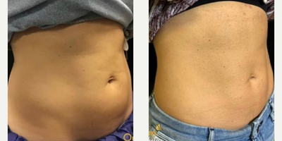 truFlex - COOLSCULPTING & TRUSCULPT FLEXTruSculptFlex creates high intensity electrical currents that closely mimic how your muscle fibers already communicate to one another when you work out. Hundreds of thousands of contractions are done rhythmically over a 45 minute treatment/workout.After freezing your fat away, get the muscle definition youve been wanting
