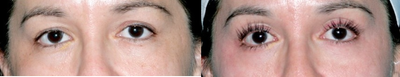 Latisse for Eyelashes - 
	Patient&#39;s eyelashes before and after using Latisse.
