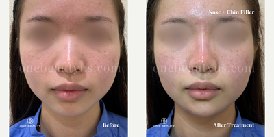 18-24 year old woman treated with Restylane Lyft, Chin Filler - two syringes of Restylane Lyft - An early 20s woman received two syringes of Restylane Lyft, one for nose filler to elevate her nose bridge and one chin filler to enhance her chin, creating better balance in her facial structure.