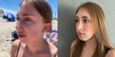 45-54 year old woman treated with Rhinoplasty - Rhinoplasty - Virtual consultation, real surgery!!