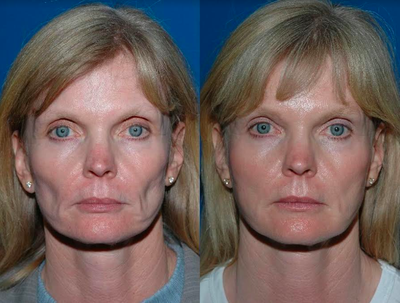 Fat grafting to face - 	Dramatic and long-standing results >7 years after fat grafting
