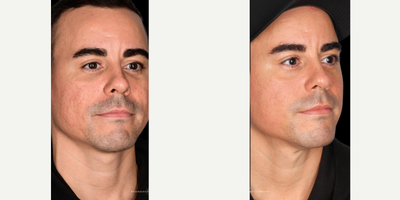 35-44 year old man treated with PCA Skin Peel - Five treatments of WIQO Peel