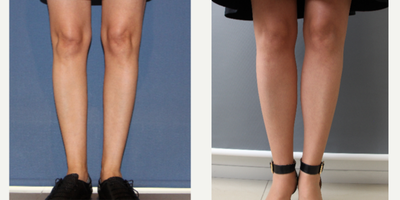 25-34 year old woman treated with Calf Implants - Calf Implants