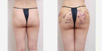 25-34 year old woman treated with Nonsurgical Butt Lift - 31 Years old female patient Chief Complain: Hip dips, abdomen & flanks, saggy buttocksTreatment Plan: full abdomen liposuction /buttocks, hip dip, butt fat transfer injectionOutcome: - abdomen liposuction pure fat : 1200cc front/ 600cc back side- hip & butt curves enhanced- balanced upper & lower body shape