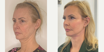 55-64 year old woman treated with Facelift, Neck Lift, Facial Fat Transfer, Chemical Peel, Eyelid Surgery - 57 year old patient 2 months after a Facelift, Neck lift, Upper Blepaharoplasty, facial fat transfer and a TCA chemical peel.