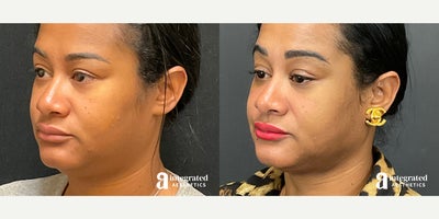 35-44 year old woman treated with AccuTite - The patient is a 36 year-old female who had aesthetic concerns with her submental/jowl region of the face. Dr. Cho performed Accutite to the lower face/neck and MyEllevate. The after results are 2 months post procedure.
