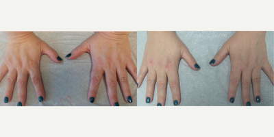 35-44 year old woman treated with Hand Rejuvenation, Radiesse, Juvederm - Hand rejuvenation with dermal filler injection (Radiesse, Juvederm) using micro-cannula technique