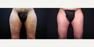 45-54 year old woman treated with Cellulaze and Smart Lipo to the Thighs - 49 year old female received Cellulaze and Smart Lipo to the thighs; photos depict the patient's results 5 months post-Cellulaze and 3 months post-Smart Lipo.