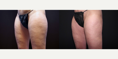 45-54 year old woman treated with Cellulaze and Smart Lipo to the Thighs - 49 year old female received Cellulaze and Smart Lipo to the thighs; photos depict the patient's results 5 months post-Cellulaze and 3 months post-Smart Lipo.