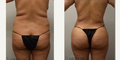 Brazilian Butt Lift - 500 cc Fat Transfer per buttock and liposculpting of the hips and waist