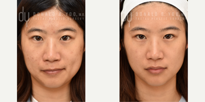 25-34 year old woman treated with PicoSure, PicoWay - Before and after 3x Picosure Picofocus treatment for hyperpigmentation and acne scars