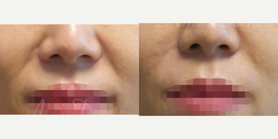 45-54 year old woman treated with Juvederm, Vollure - Treatment of nasolabial folds (laugh lines) and marionette lines with Juvederm, Radiesse, Vollure, Restylane or Bellafill injected with cannula
