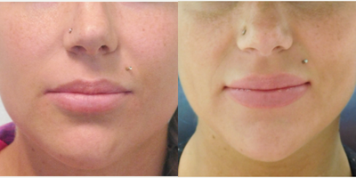 30 year old woman treated with Permanent Lip Implants - This young woman wished for increased size of the red portion of her upper and lower lips. She had grown tired of using temporary fillers and wanted a more permanent result. In our office, under local anesthesia, we placed 5mm Permalip implants in both the top and bottom lip.  Her results demonstrate larger, and fuller, natural appearing lips.