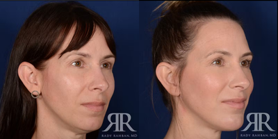 45-54 year old woman treated with Facelift - Facelift