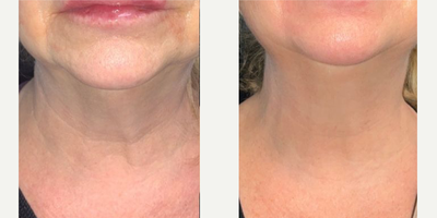 55-64 year old woman treated with Alastin Skincare, Nonsurgical Neck Lift - 8 weeks of consistent Alastin SkinCare Neck Cream