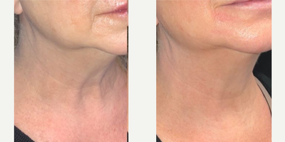 55-64 year old woman treated with Alastin Skincare, Nonsurgical Neck Lift - 8 weeks of consistent Alastin SkinCare Neck Cream