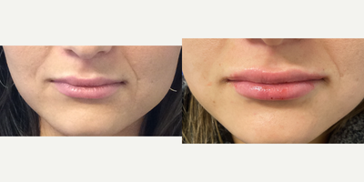 18-24 year old woman treated with Volbella - Volbella lip filler immediately after injection. By Steve