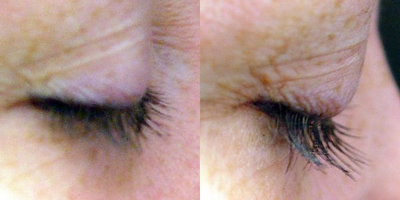 Dr. Lorrie Klein's eyelashes before and after Latisse - 
	These are my own eyelashes treated with Latisse.
