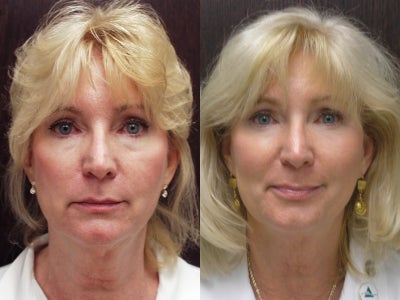 65 year old female treated with Sculptra for loss of volume - 65 year old female with loss of volume in face. Only previous surgery was rhinoplasty performed by me. She had two sessions 6 weeks apart using Sculptra, each session with 10 ml.