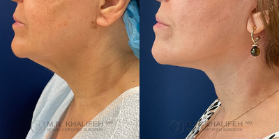 45-54 year old woman treated with Neck Lift - A neck lift can be performed with a limited incision that starts at the ear lobe and goes behind the ear and into the occipital area. These incisions will allow for muscle tightening and skin removal to rejuvenate the neck region.