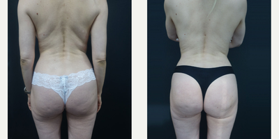 35-44 year old woman treated with Brazilian Butt Lift - Brazilian Butt Lift with Fat Injection & Vaser Liposuction - 500 ml. Each Side