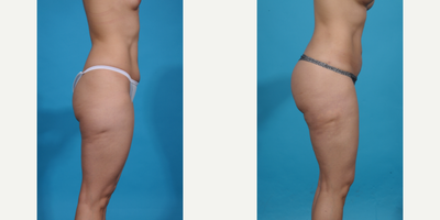 25-34 year old woman treated with Brazilian Butt Lift, Brazilian Butt Lift Revision, Butt Augmentation, Butt Lift, Liposculpture - Skinny BBL. This patient wanted better shape and curves without too much volume. A skinny BBL prioritizes shape over size and is perfect for athletic women who just need a better shape, more curves, and projection but don't want too much volume in their butt. We call this a skinny BBL.