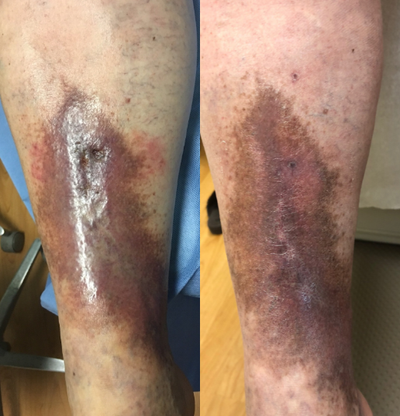 65-74 year old woman treated with EVLT - 65 year old female, with 2 years history of leg ulcer, and dermatitis. Ulcer has been healed 2 months after closing the refluxing veins in her legs, and the skin color started improving.