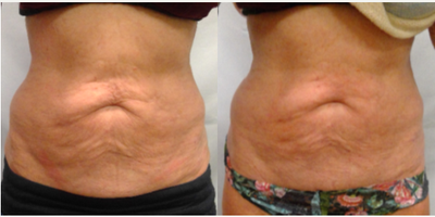 65-74 year old woman treated with BodyFX - Patient after 1 treatment