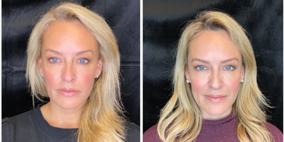 45-54 year old woman treated with Morpheus8 - Uncover your naturally, youthful contours with Morpheus8 full face and neck. This is before & after was taken 3 months after her last treatment. Morpheus8 is a medical grade, microneedling device that utilizes radiofrequency energy to remodel & contour the face & body via subdermal adipose remodeling. This fractional treatment penetrates deep into the skin & fat for a smoother and sleeker appearance. By targeting the deeper layers of the skin, your natural building blocks will reorganize themselves in an anti-aging process. Morpheus8 can be combined with PRP for optimal results!