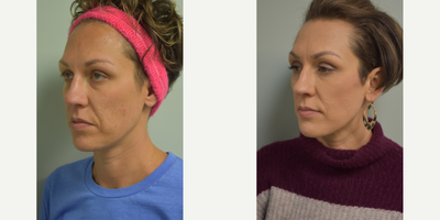 35-44 year old woman treated with Genius - Genius RF Micro-needling