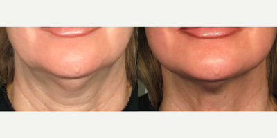 Woman treated with ULTRAcel - Woman treated with ULTRAcel