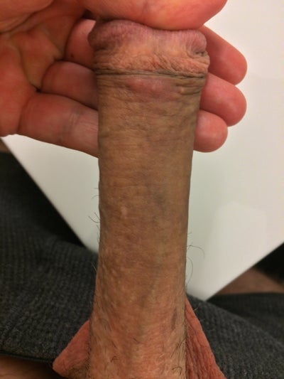 What Are These White Bumps On My Penis 25
