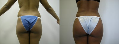 Butt Augmentation - 