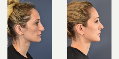 Woman treated with Ear Surgery - Woman treated with Ear Surgery.