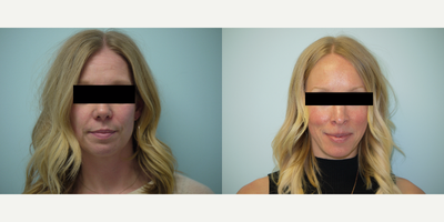 35 year old woman treated with Restylane Lyft - 35 year old woman treated with Restylane Lyft