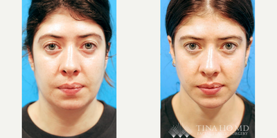 25-34 year old woman treated with Mini Neck Lift, Chin Filler, Neck Lift - 33 year-old female who underwent deep mini neck lift with chin augmentation with filler for jawline contouring and neck rejuvenation