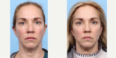 45-54 year old woman treated with PicoWay, Vbeam - To reduce the signs of aging and sun damage, this patient was treated three times with a combination of PicoWay, Vbeam, and Lutronic Ultra Laser. Her results are shown 1 month after her third session.