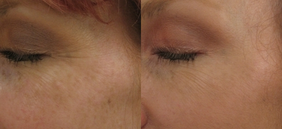 Crows feet after a single 1540 Lux Fractional Laser Treatment - 
	Crows feet treated with the 1540 Fractional Laser.&nbsp;
