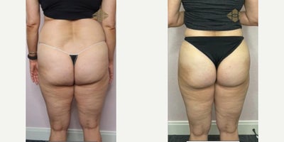 Woman treated with BeautiFill, Laser Liposuction - Woman treated with BeautiFill, Laser Liposuction