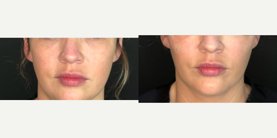 35-44 year old woman treated with Radiesse, Skin Rejuvenation, Dermal Fillers, Cheek Fillers - This client was unhappy with her jaw line and lack of fullness in her cheeks. We placed a total of 2 syringes of Radiesse. 1/2 of a syringe to each cheek and 1/2 of a syringe to each side of her jaw to help contour and lift.Radiesse stimulates your bodys natural collagen, filling in wrinkles long term and helping your skin develop new collagen in the process.